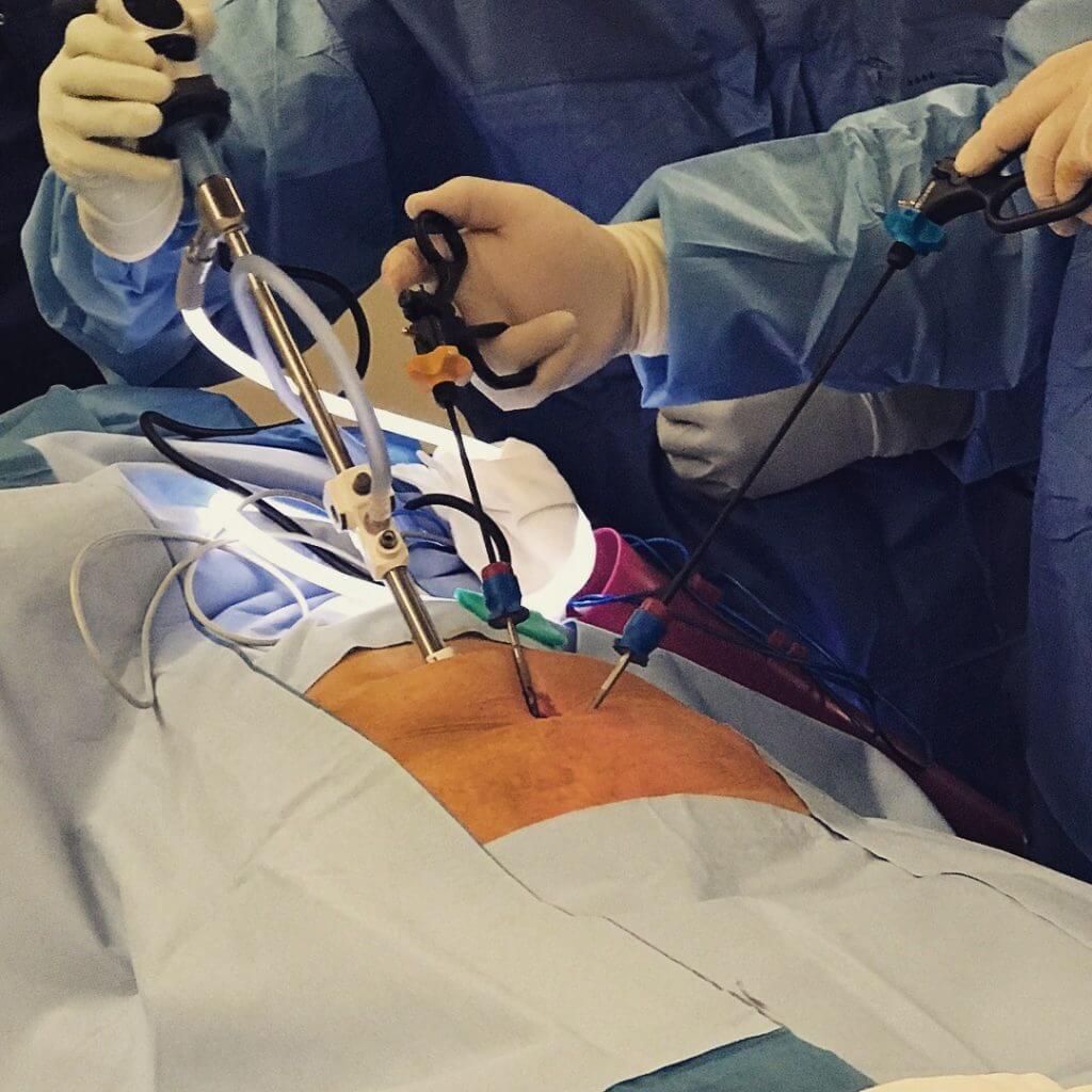 mini-laparoscopic hernia operation